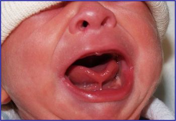 Короткая уздечка языка у ребенка – нужно ли ее подрезать